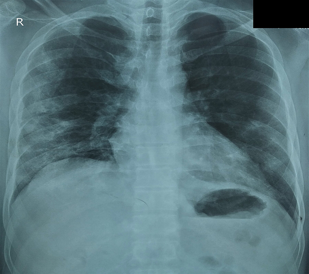 Cureus Spontaneous Pneumomediastinum in COVID19 Pneumonia
