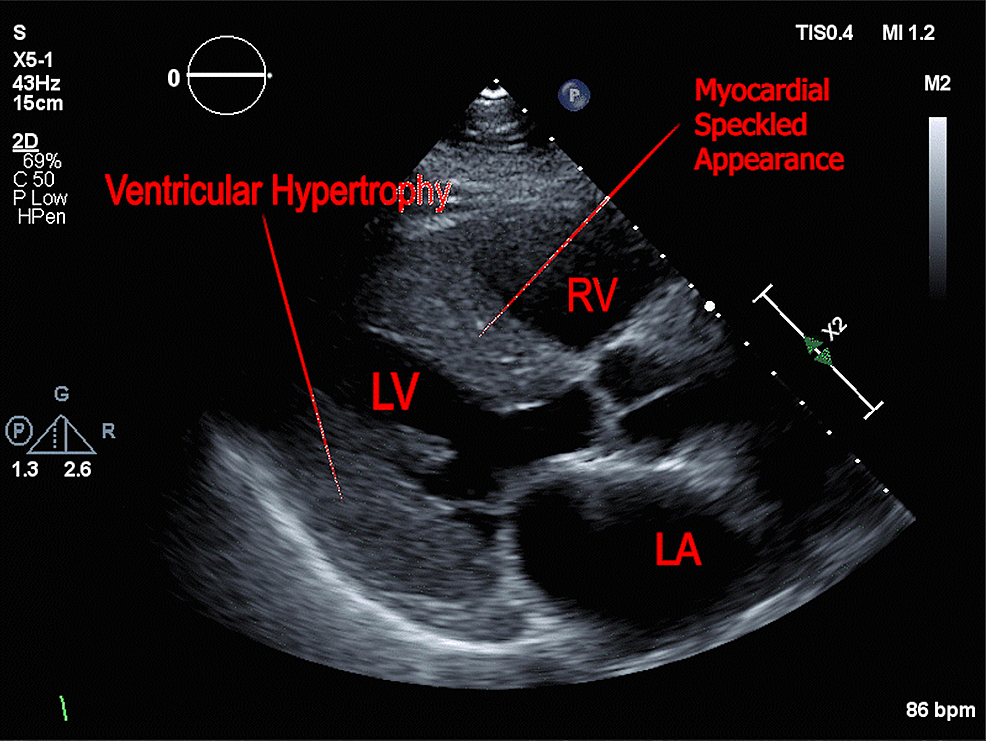 Cureus Ruptured Bullae A Case Of Transthyretin Cardiac Amyloidosis