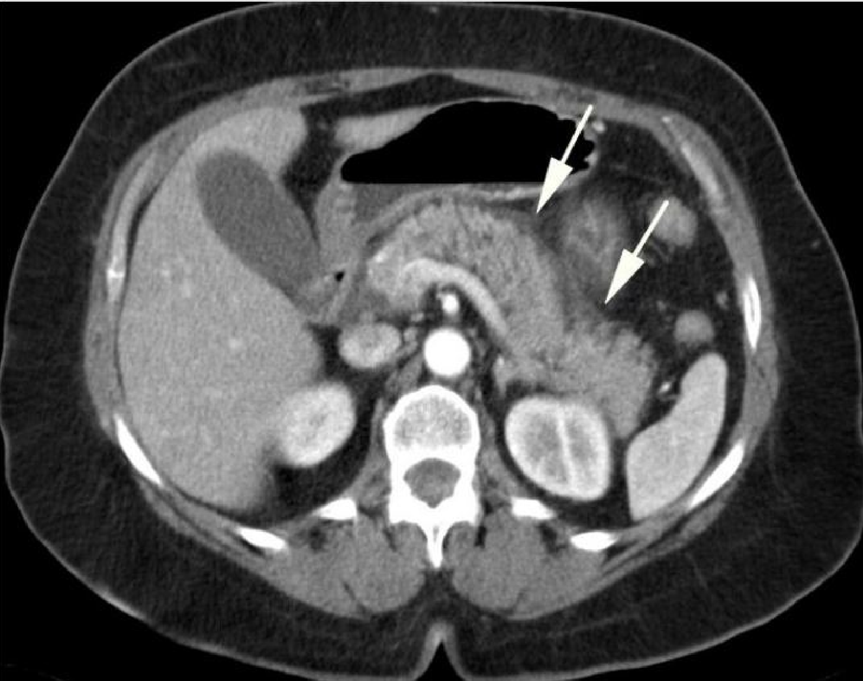 Cureus Acute Interstitial Pancreatitis With a Normal Lipase Level in