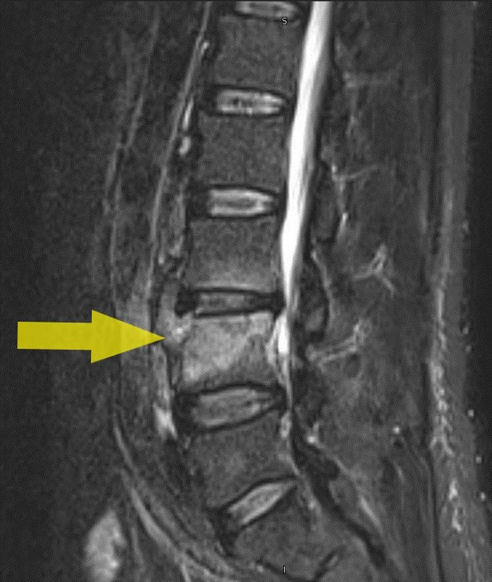 Cureus | Complicated Brucellosis With Multisystem Involvement: Two Case ...