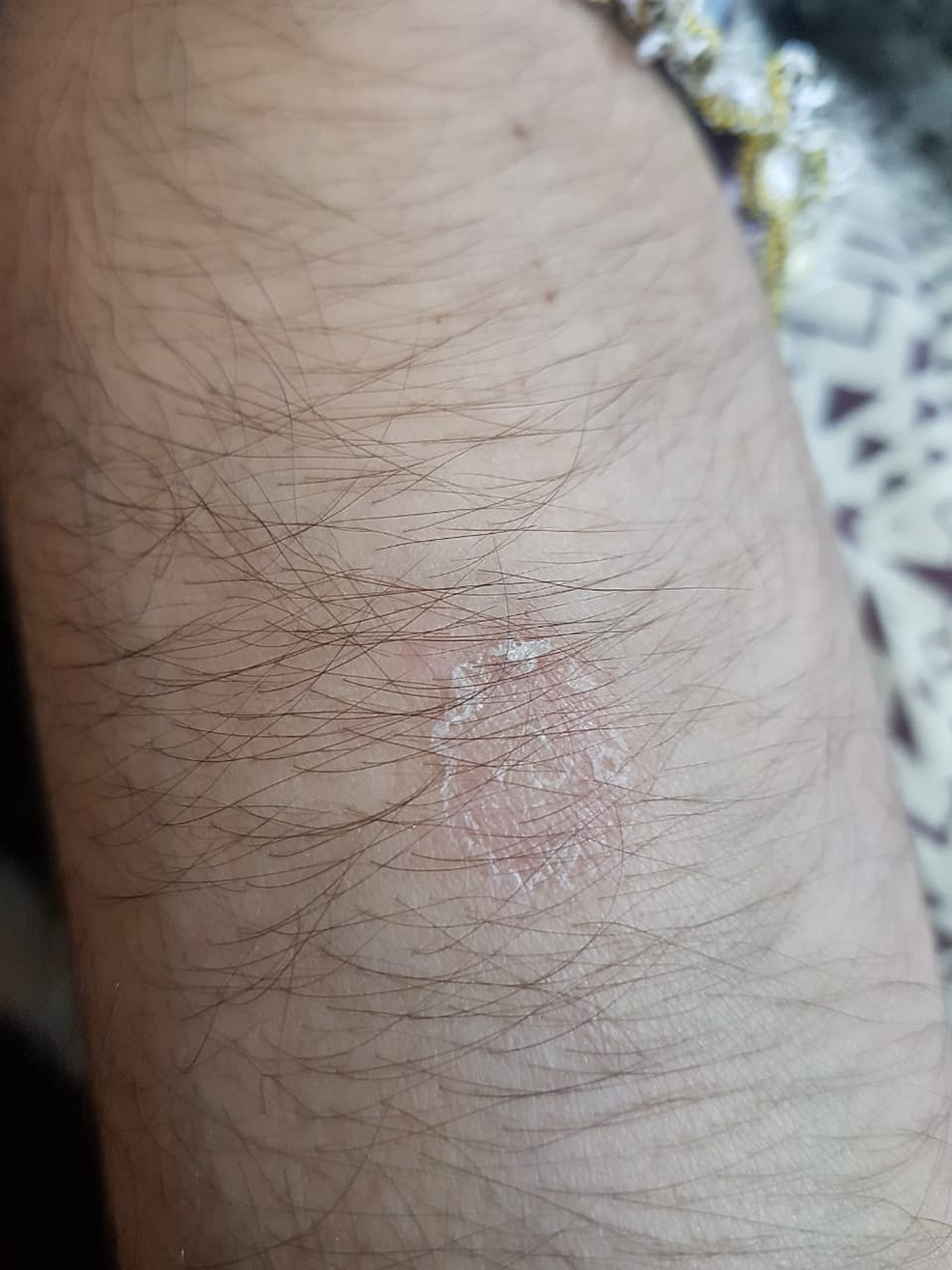 Cureus Hereditary Chorea Associated With and Aggravated by Systemic