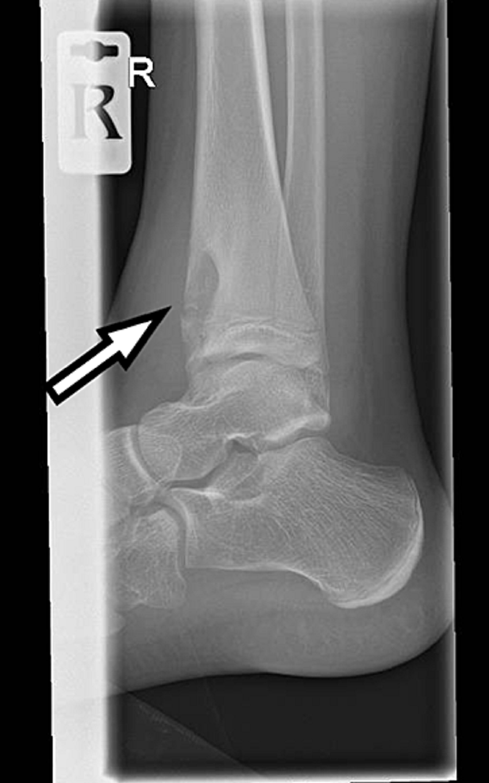 Cureus Brodie s Abscess A Diagnostic Conundrum Article