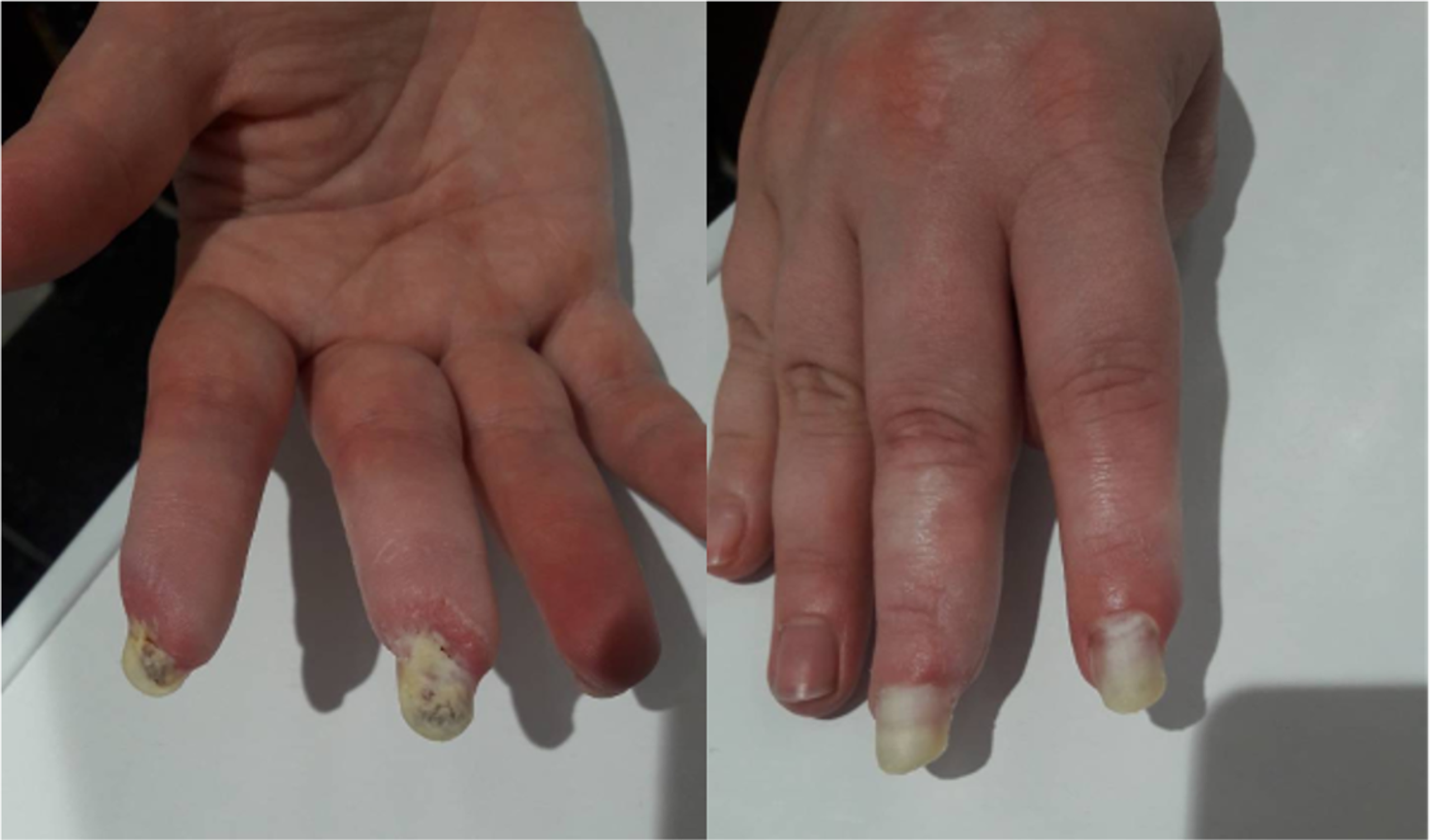 Cureus Clinical Puzzles and DecisionMaking in Antisynthetase Syndrome