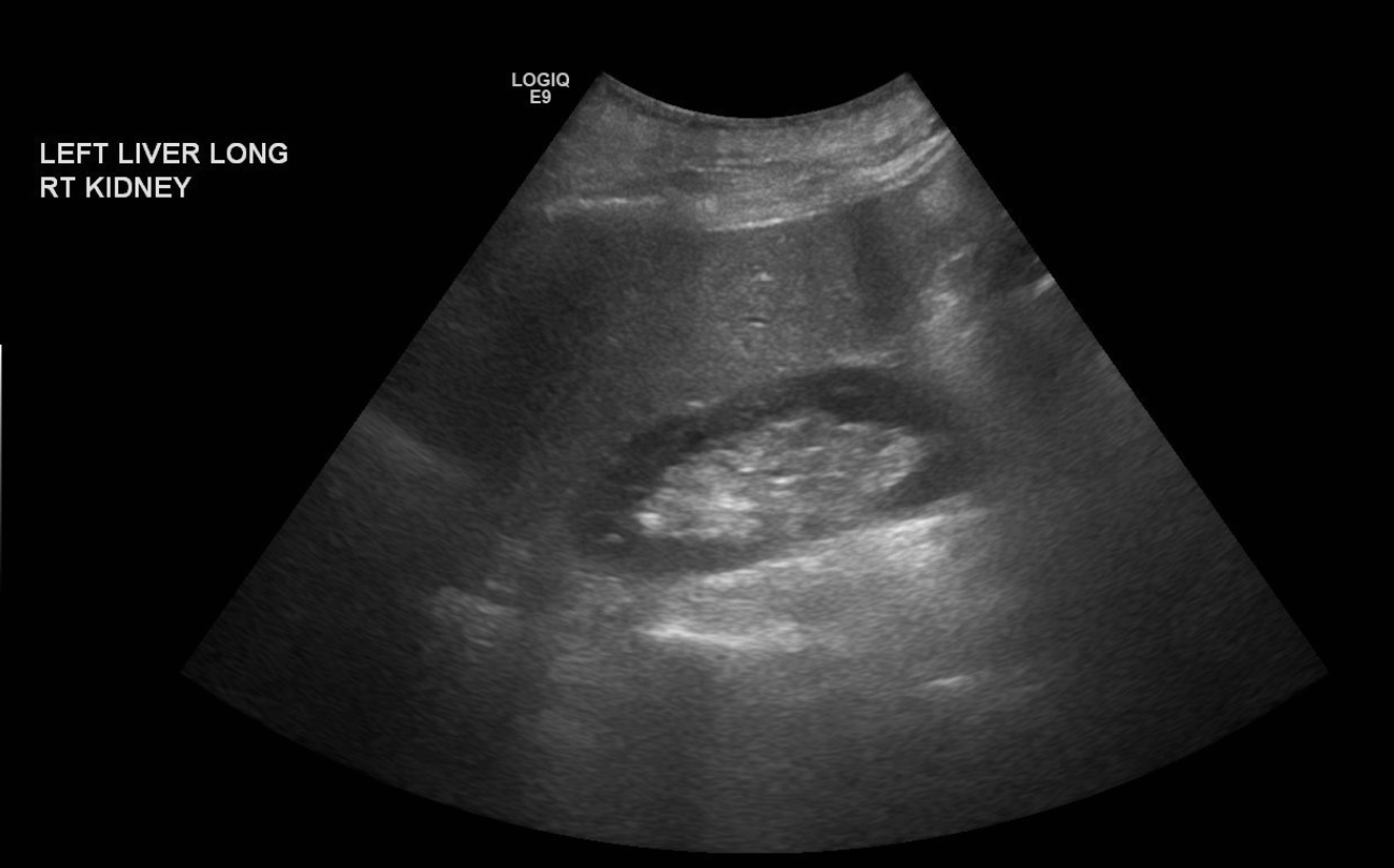 Cureus Chronic Liver Disease A Mimic of Systemic Lupus Erythematosus
