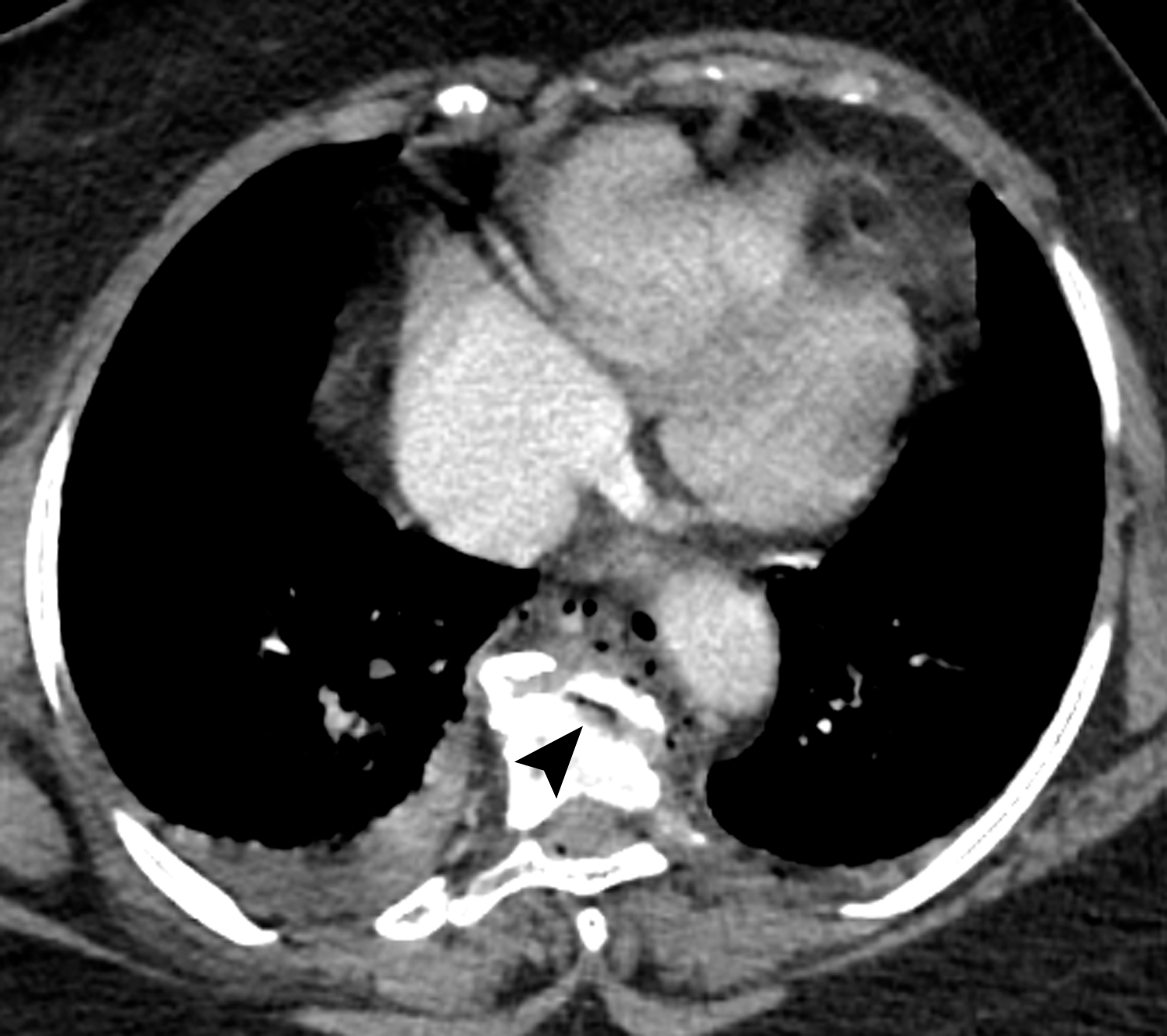 Cureus Pneumomediastinum From Vacuum Disc and Vertebral Trauma
