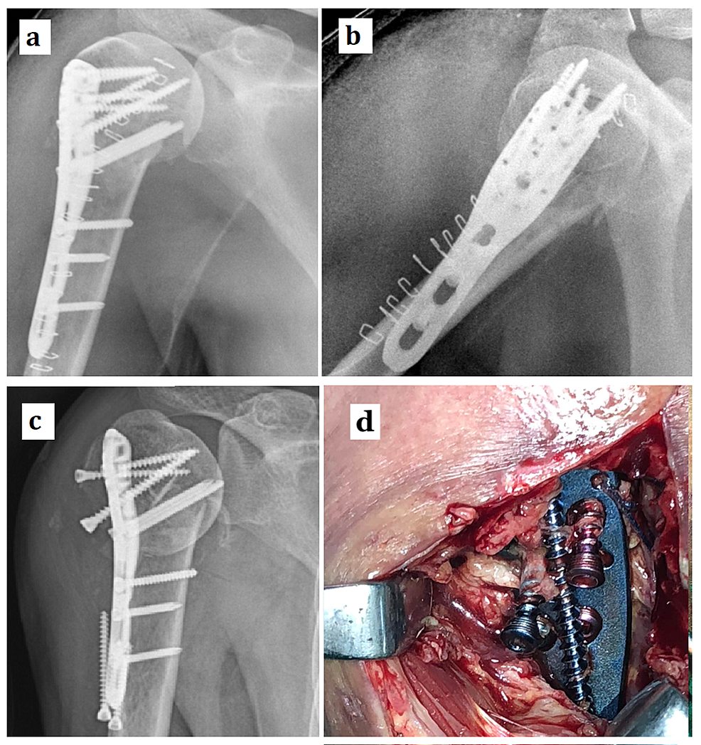 Postoperative-radiographs,-AP-(a)-and-lateral-(b),-of-a-two-part-proximal-humerus-fracture-fixed-with-a-proximal-humerus-locking-plate-have-been-shown.-Following-a-seizure-episode,-the-patient-sustained-a-catastrophic-fracture-fixation-failure-with-varus-collapse-of-fracture-(c).-During-the-revision-surgery,-the-intraoperative-picture-(d)-shows-the-proximal-locking-cancellous-screws-migrated-out-of-the-proximal-fragment.