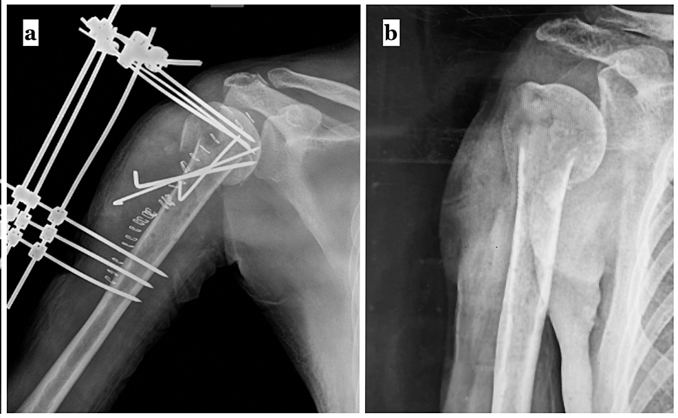 (a)-A-simple-pin-based-external-fixator-was-used-to-salvage-the-implant-failure-following-the-seizure-episode.-(b)-Follow-up-radiograph-at-two-months-after-the-second-surgery.