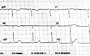 Cureus | Wellens Syndrome: An Atypical Presentation With Burning Chest