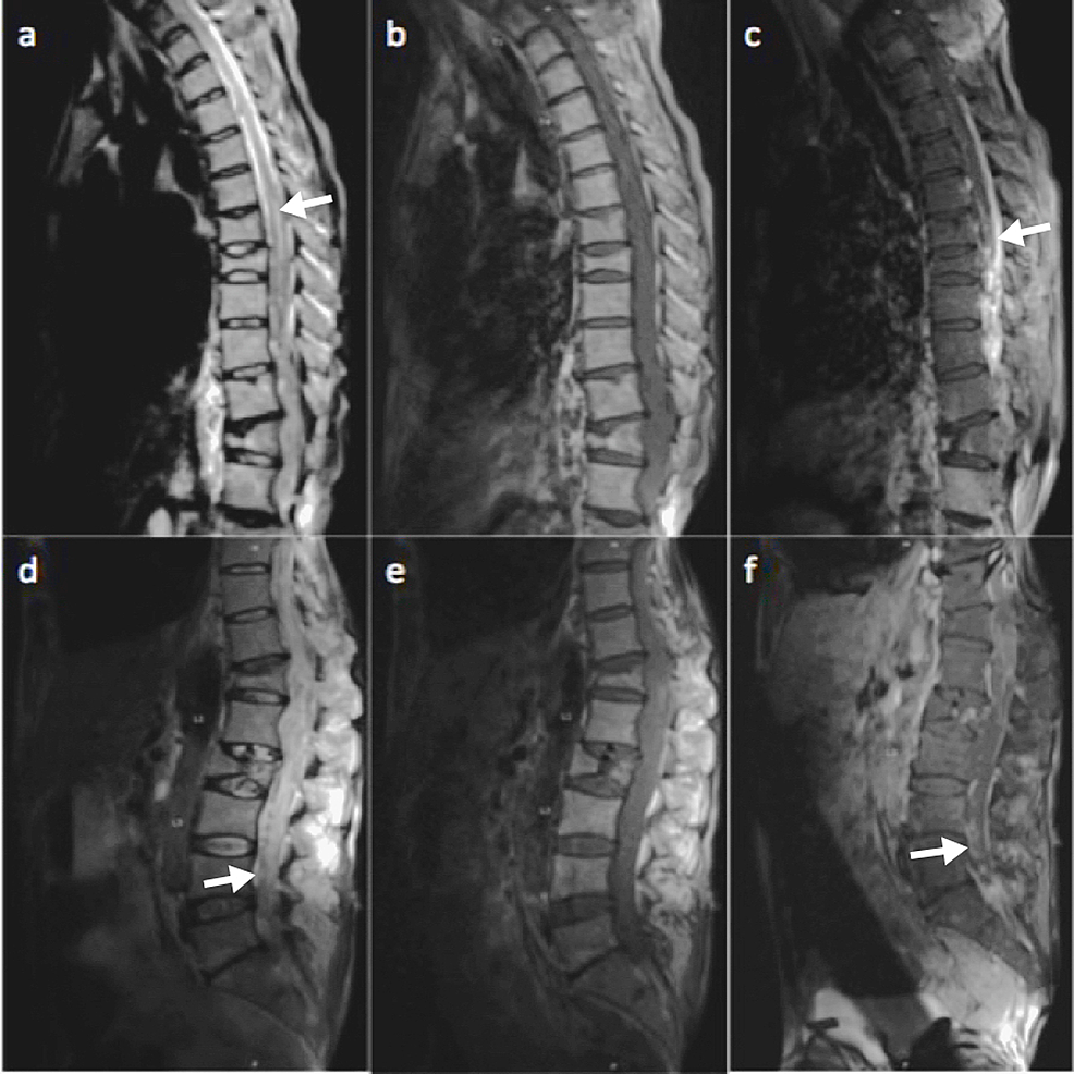 cureus-spinal-epidural-abscess-in-melioidosis-a-rare-case-report