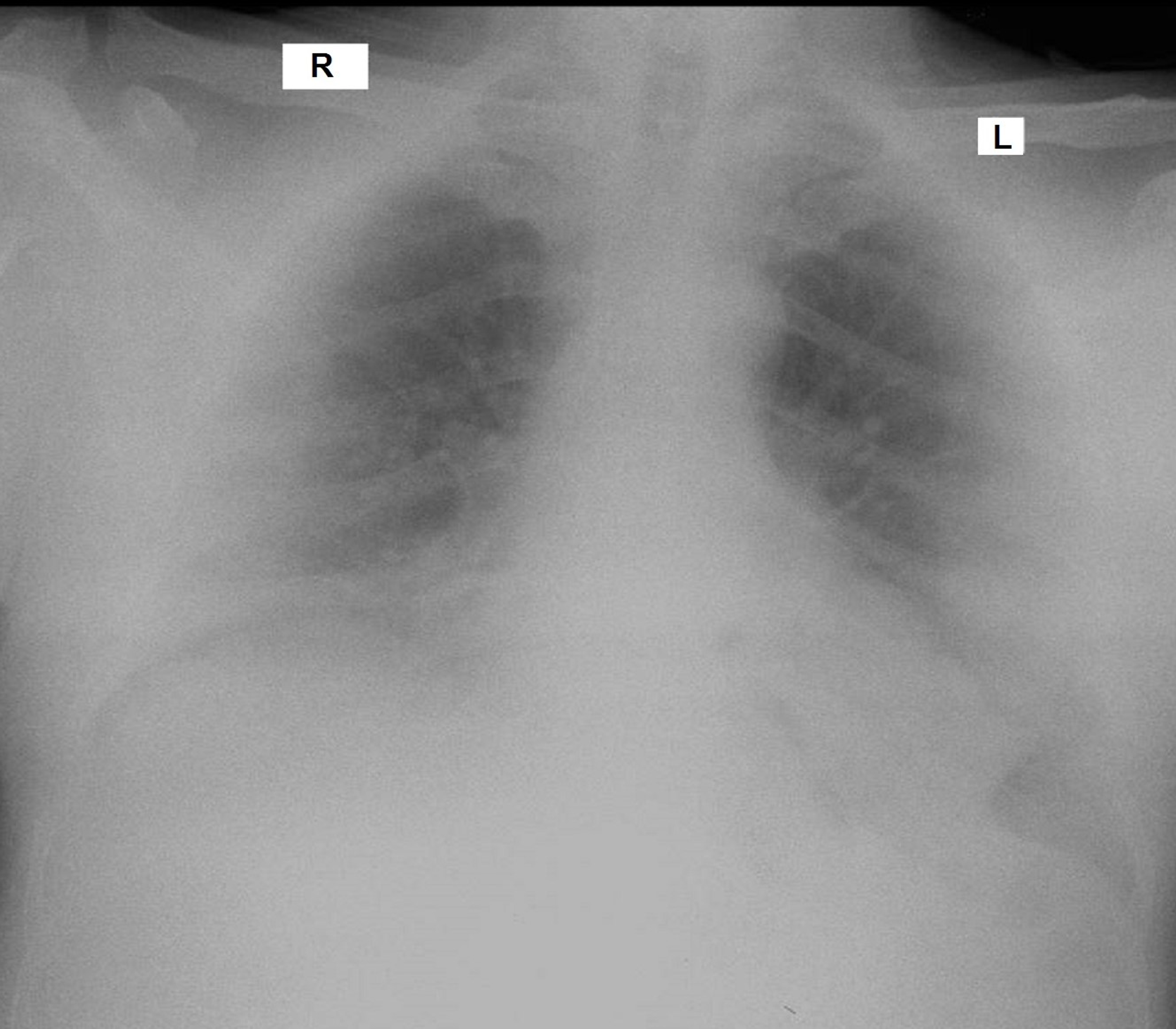 Cureus COVID19 InfectionRelated Coagulopathy and Acute Limb Ischemia in a Patient With Pre