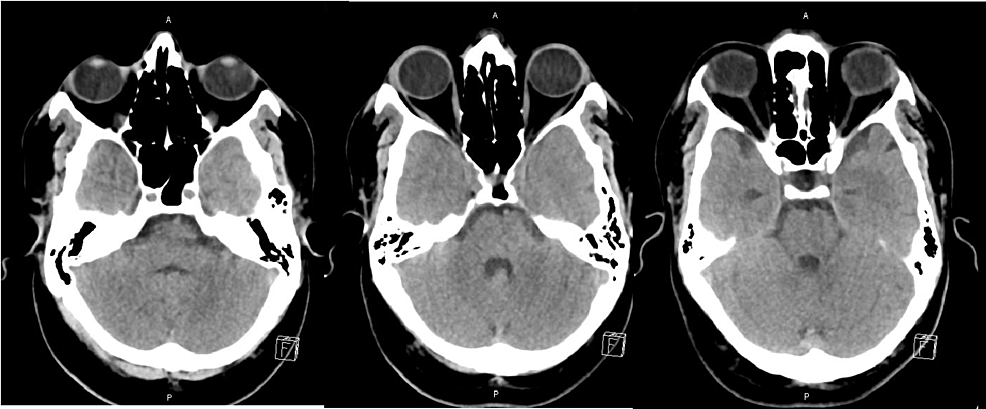 Axial-noncontrast-CT-head-of-the-patient-at-the-level-of-pons/posterior-fossa-(multiple-sections)-showing-no-abnormalities.