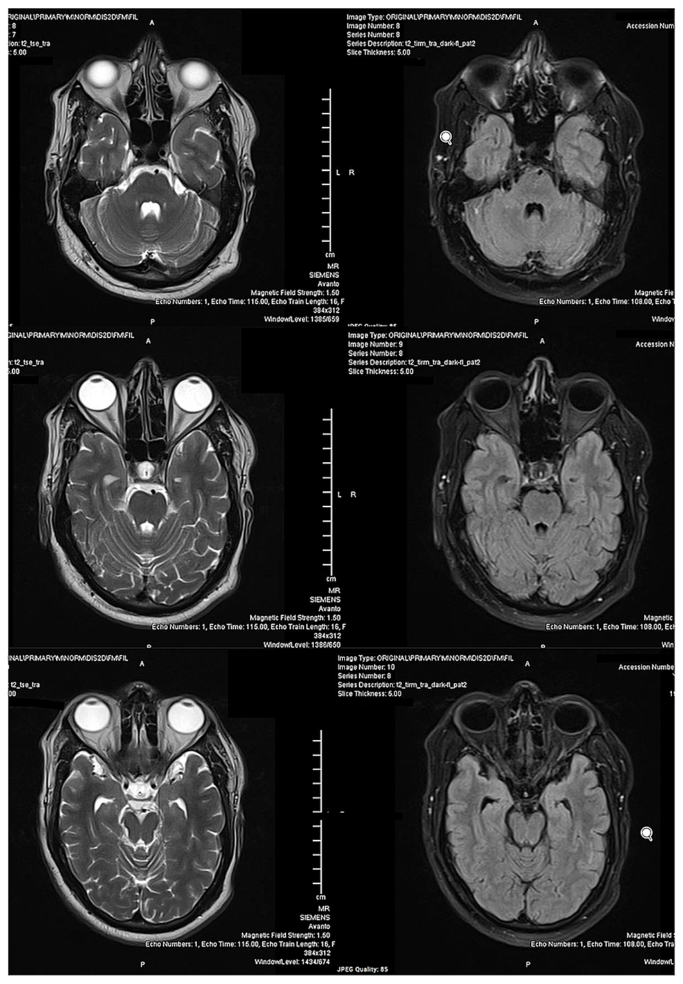 MRI-brain-of-the-patient-with-T2-weighted-images-(left)-and-FLAIR-images-(right)-at-the-level-of-the-pons-showing-no-abnormality.