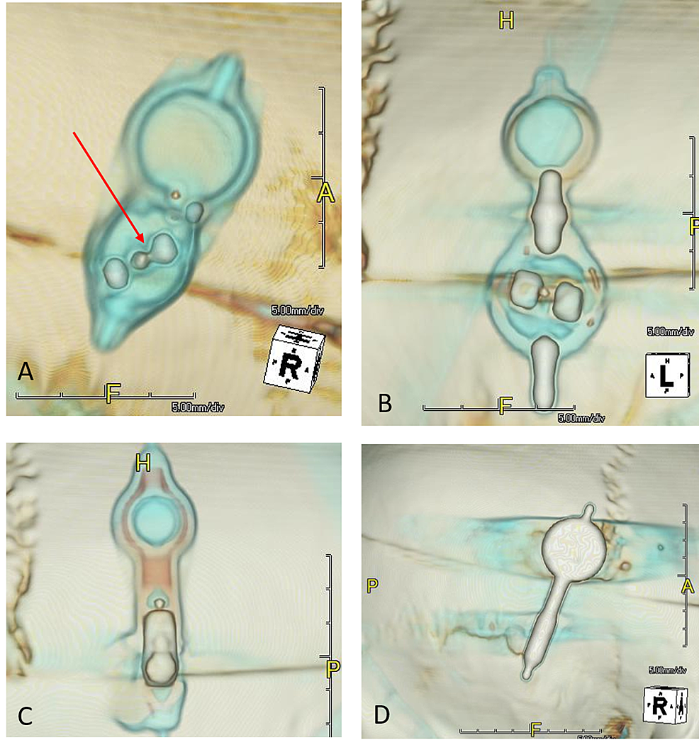 Cureus Determination of Programmable Shunt Setting Using CT
