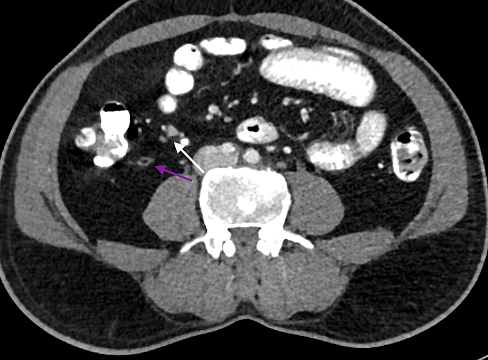 cureus-mesenteric-lymphadenitis-due-to-covid-19-in-an-adult