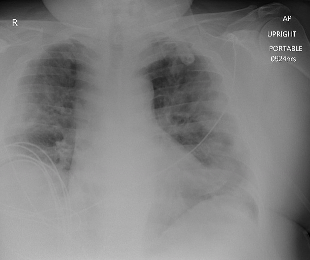 Patient’s-initial-emergency-department-chest-radiograph.-Bilateral-airspace-consolidations-with-no-acute-osseous-abnormalities-are-shown,-a-consistency-found-with-acute-respiratory-distress-syndrome.