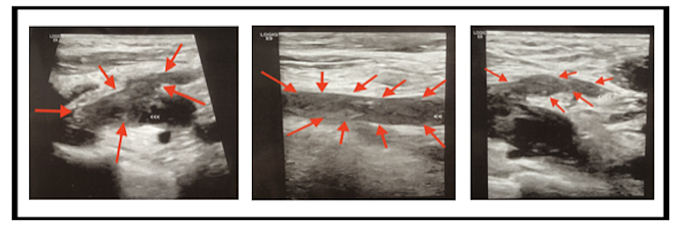 Ultrasound-of-bilateral-lower-extremities-by-Grayscale-Doppler-with-color-flow-spectral-broadening.-These-demonstrate-extensive-bilateral-deep-venous-thrombosis.