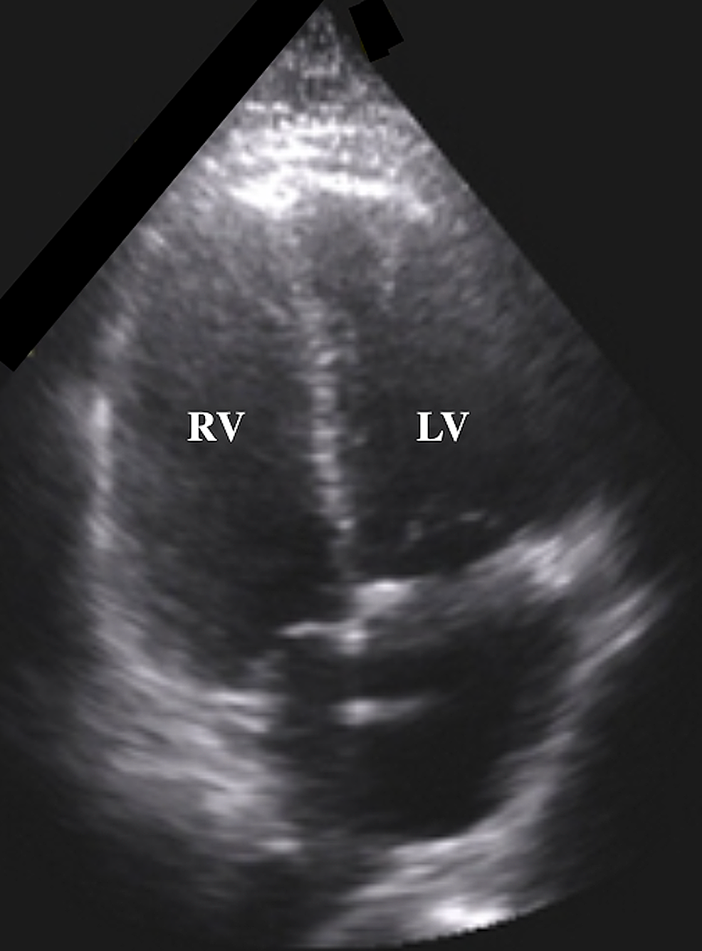 Bedside-point-of-care-ultrasound-(POCUS)-during-CPR-showed-a-dilated-RV-and-an-RV:LV-ratio-greater-than-1,-indicating-an-increase-in-RV-afterload-likely-secondary-to-a-PE-given-the-clinical-context.