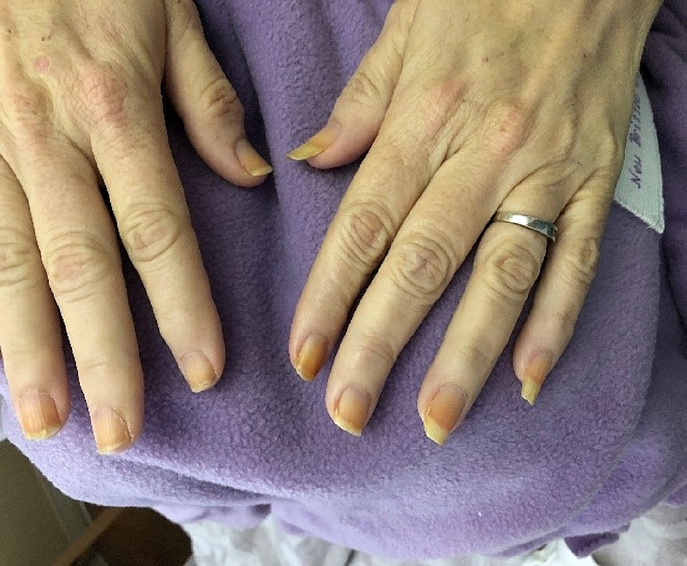 Yellow Nail Syndrome: Treatment of Lymphedema Using Low Pressure Compression