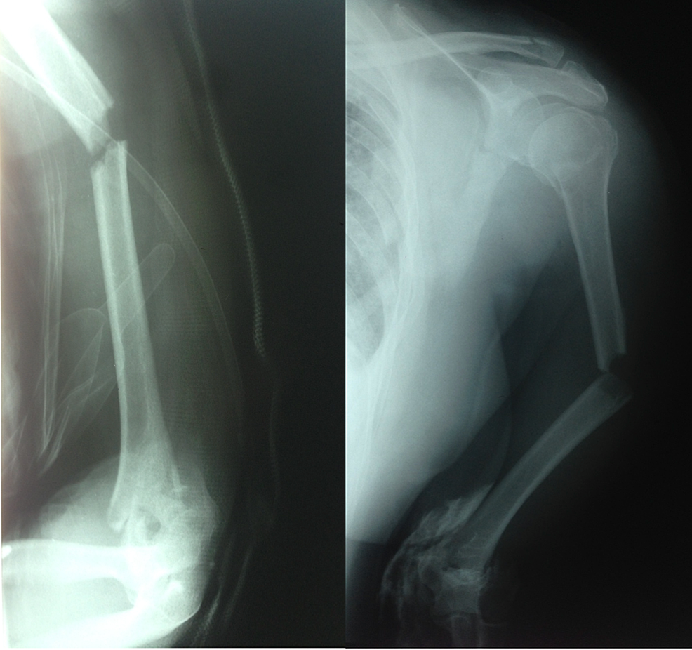 Humeral lengthening using a lower extremity device | Complex Case | For  Clinicians | Orthopedic Center | Centers | Boston Children's Hospital