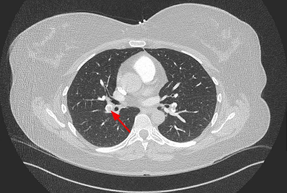 Early Thrombosis Of Splenic Artery Stent Graft | Cureus