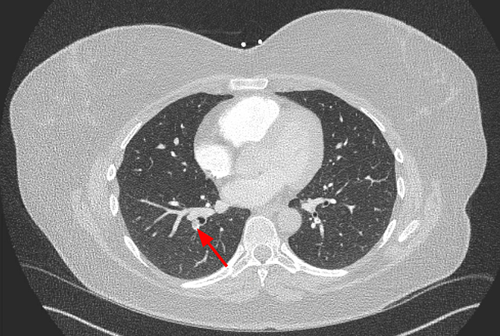 Cureus | Early Thrombosis of Splenic Artery Stent Graft