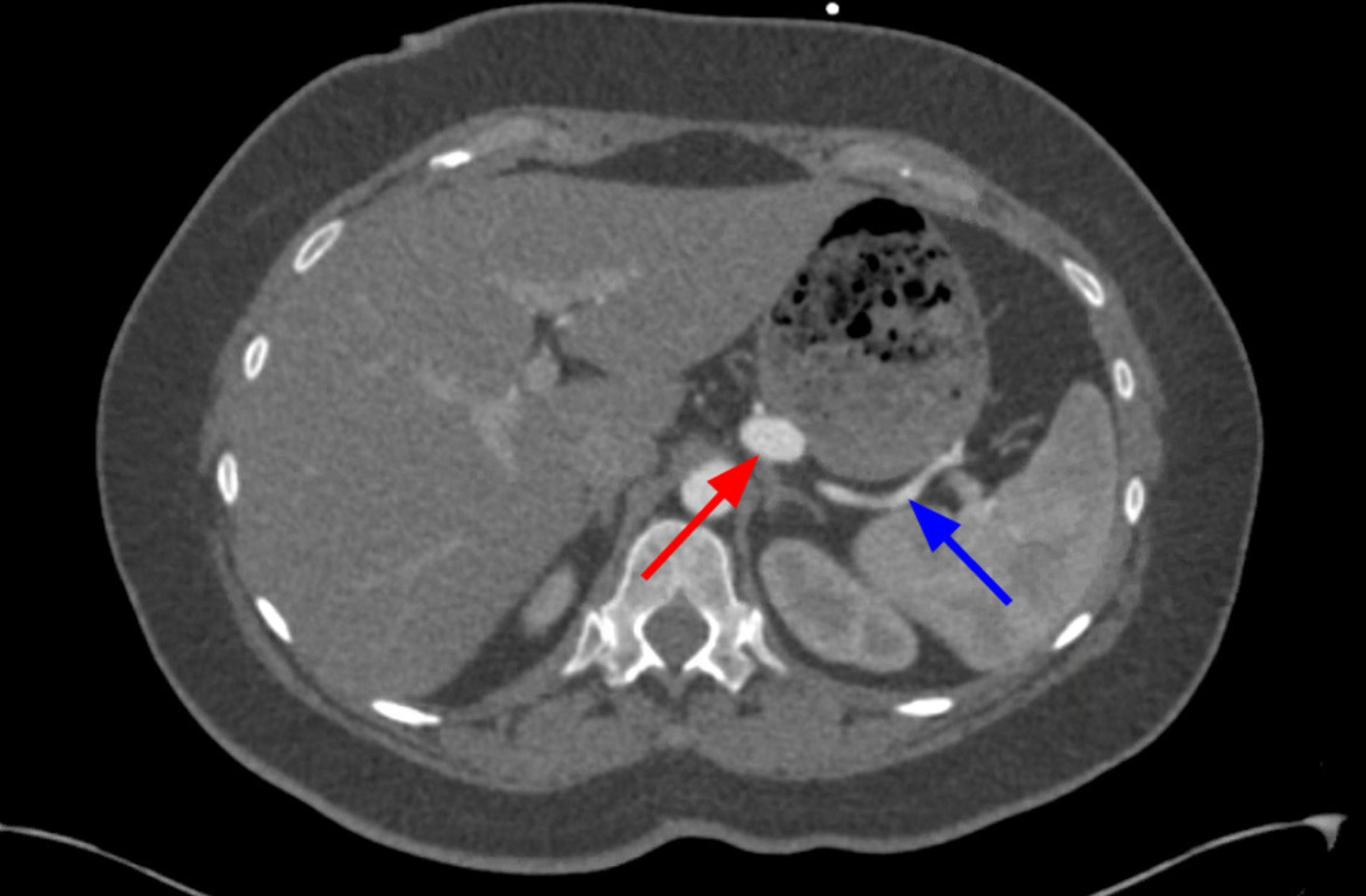 Cureus Early Thrombosis Of Splenic Artery Stent Graft 8595