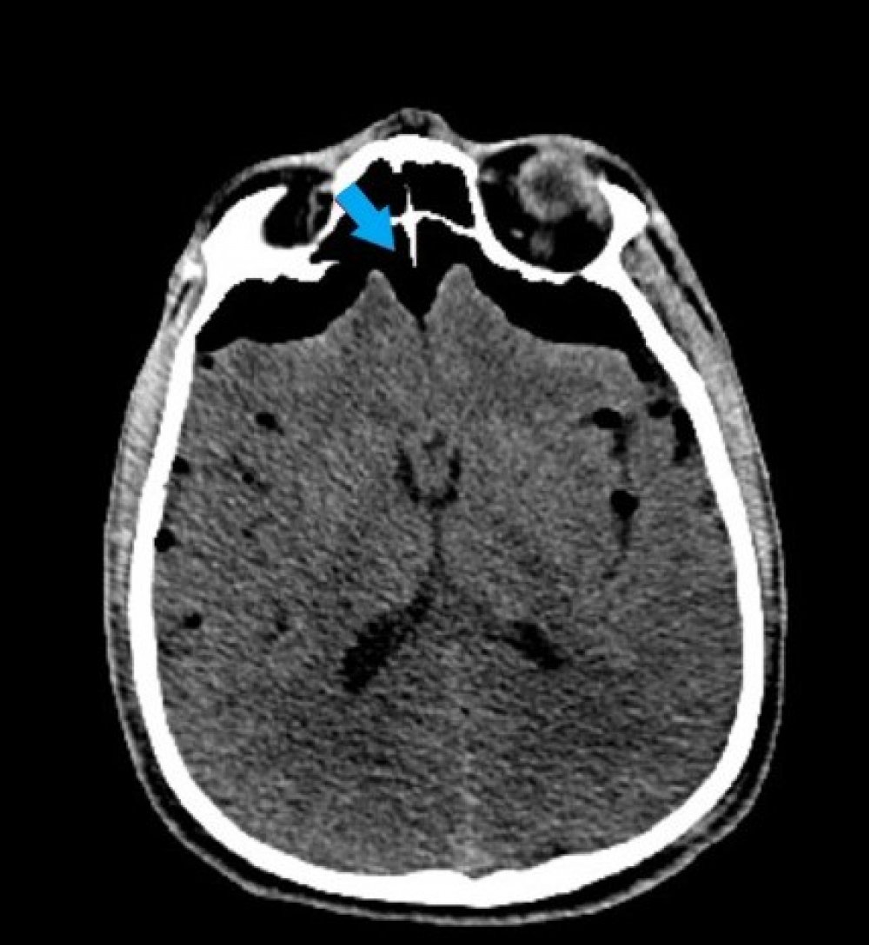 Rare Case Of Tension Pneumocephalus In Thoracic Trauma Cureus