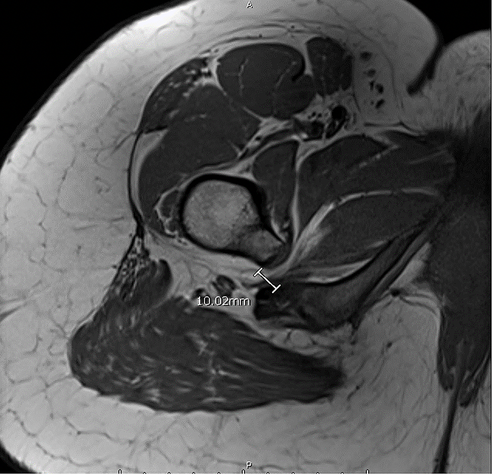 Belly Up or Down What are we missing? Prone vs. Supine MRI