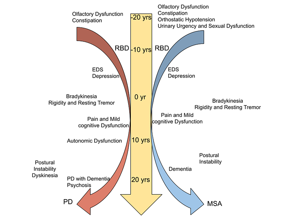 Cureus The Correlation Between Parkinson’s Disease and Rapid Eye