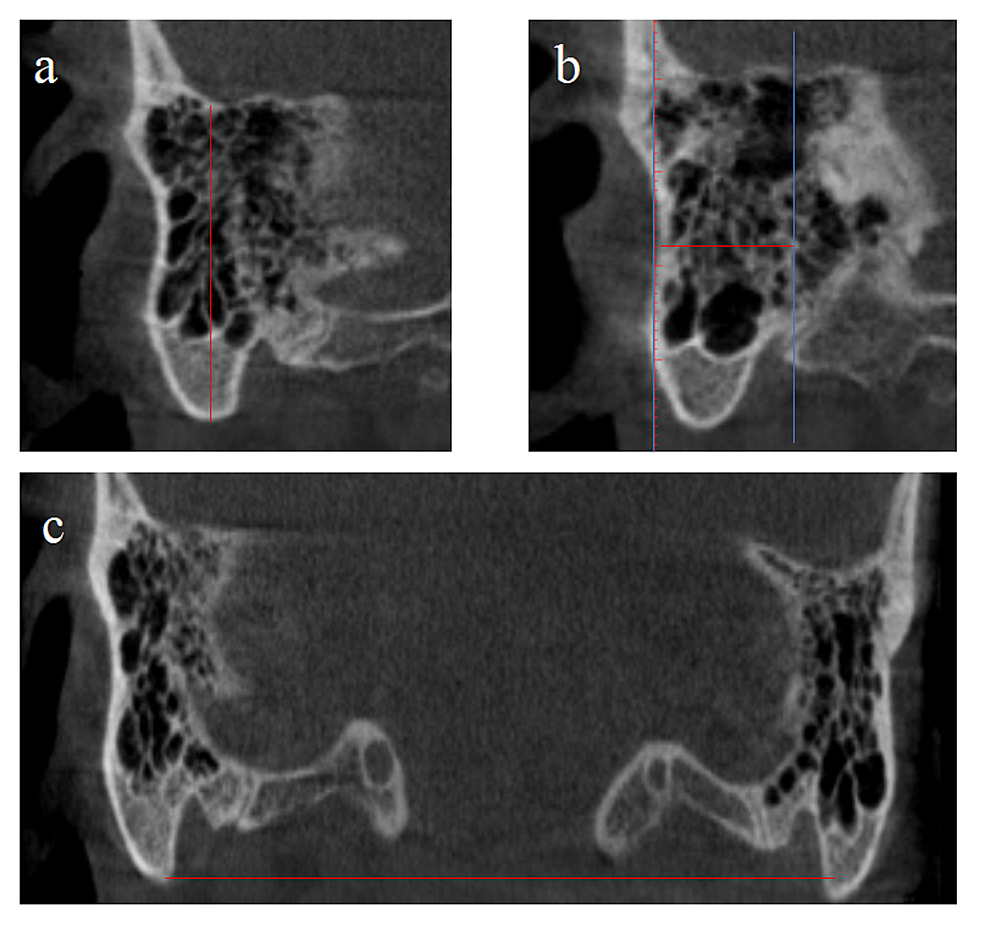 The Radiological Evaluation Of The Mastoid Process And Its Implications ...