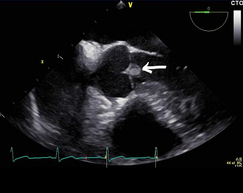 Slither Into the Heart: Salmonella Endocarditis Following Rattlesnake ...