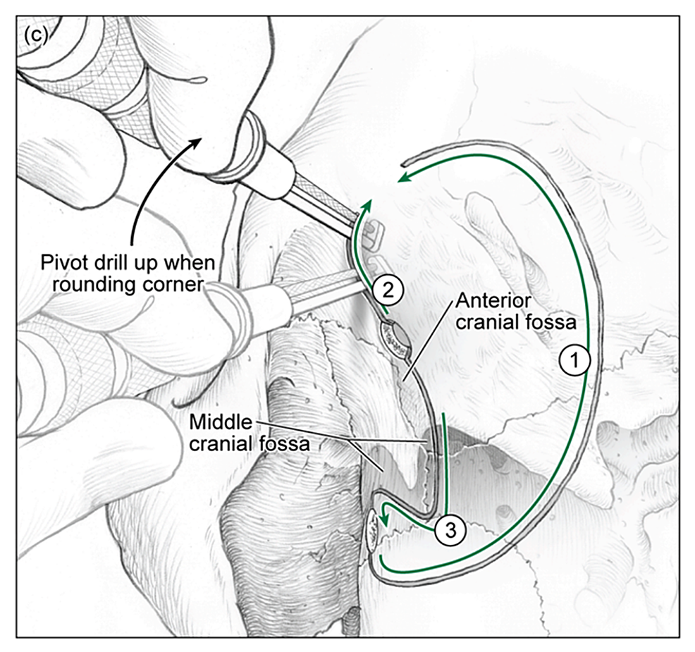 รวมกัน 92+ ภาพพื้นหลัง Craniotomy การ พยาบาล ความละเอียด 2k, 4k 11/2023