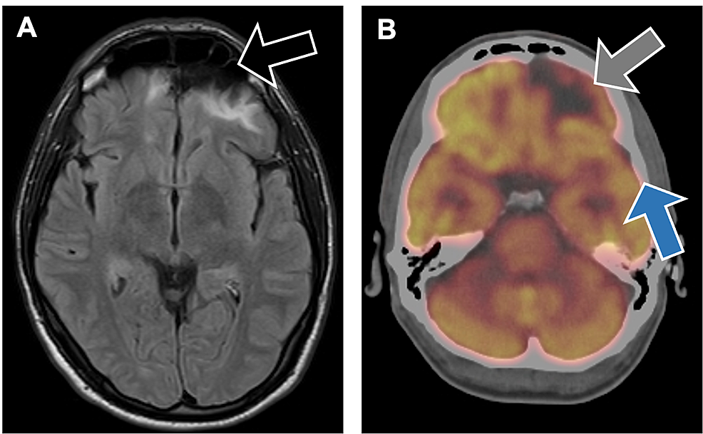 A.-MRI-brain-scan-revealing-encephalomalacia-of-both-inferior-frontal-lobes-(black-arrow)-and-left-anterior-temporal-lobes-related-to-the-patient's-traumatic-brain-injury.-B.-Positron-emission-tomography-brain-scan-demonstrating-photopenia-in-the-left-frontal-lobe-(gray-arrow)-and-to-a-lesser-extent-in-the-left-temporal-(blue-arrow)-and-right-medial-frontal-lobe.