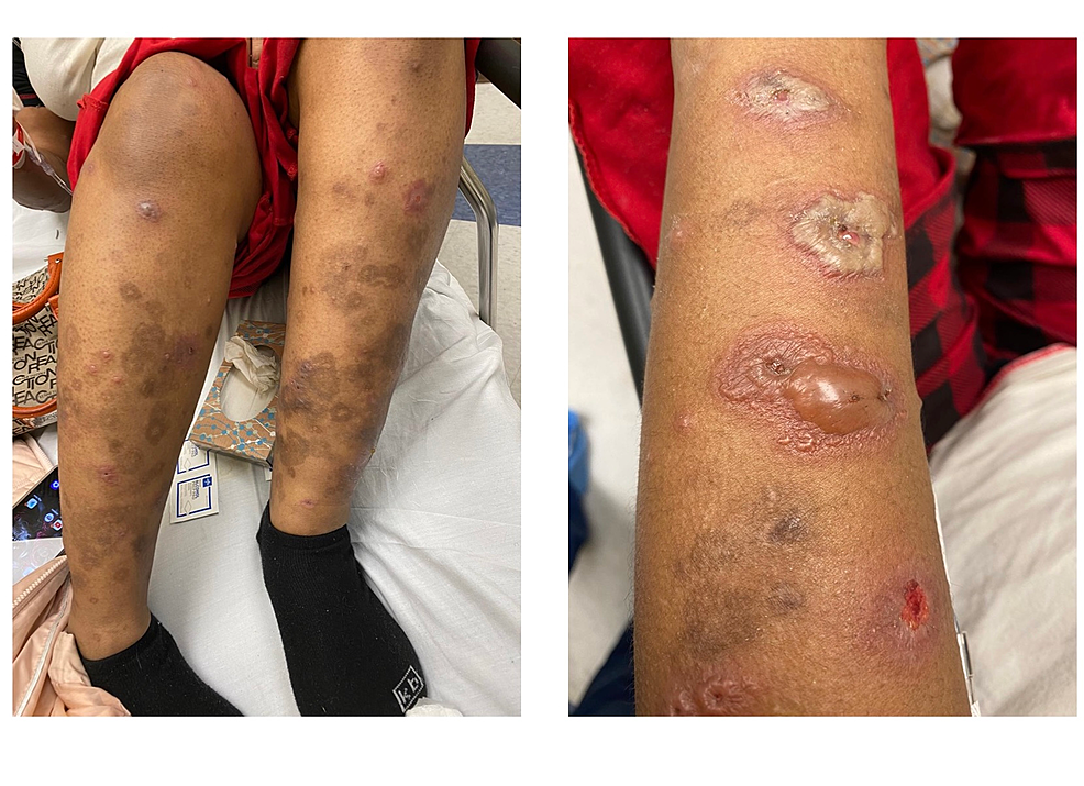 Cureus Autoimmune Progesterone Dermatitis