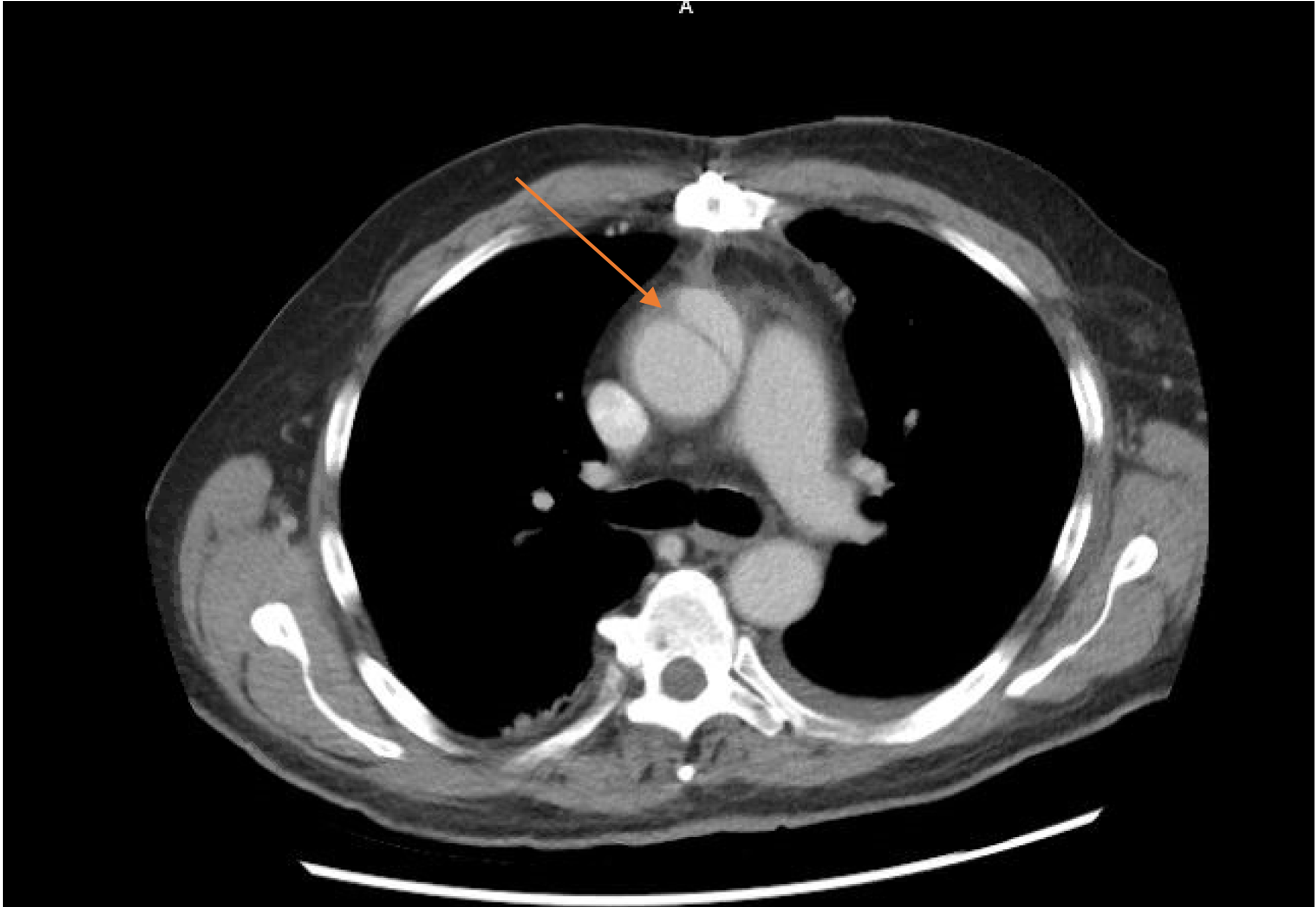 Cureus Successful Medical Management of an Acute Ascending Aortic
