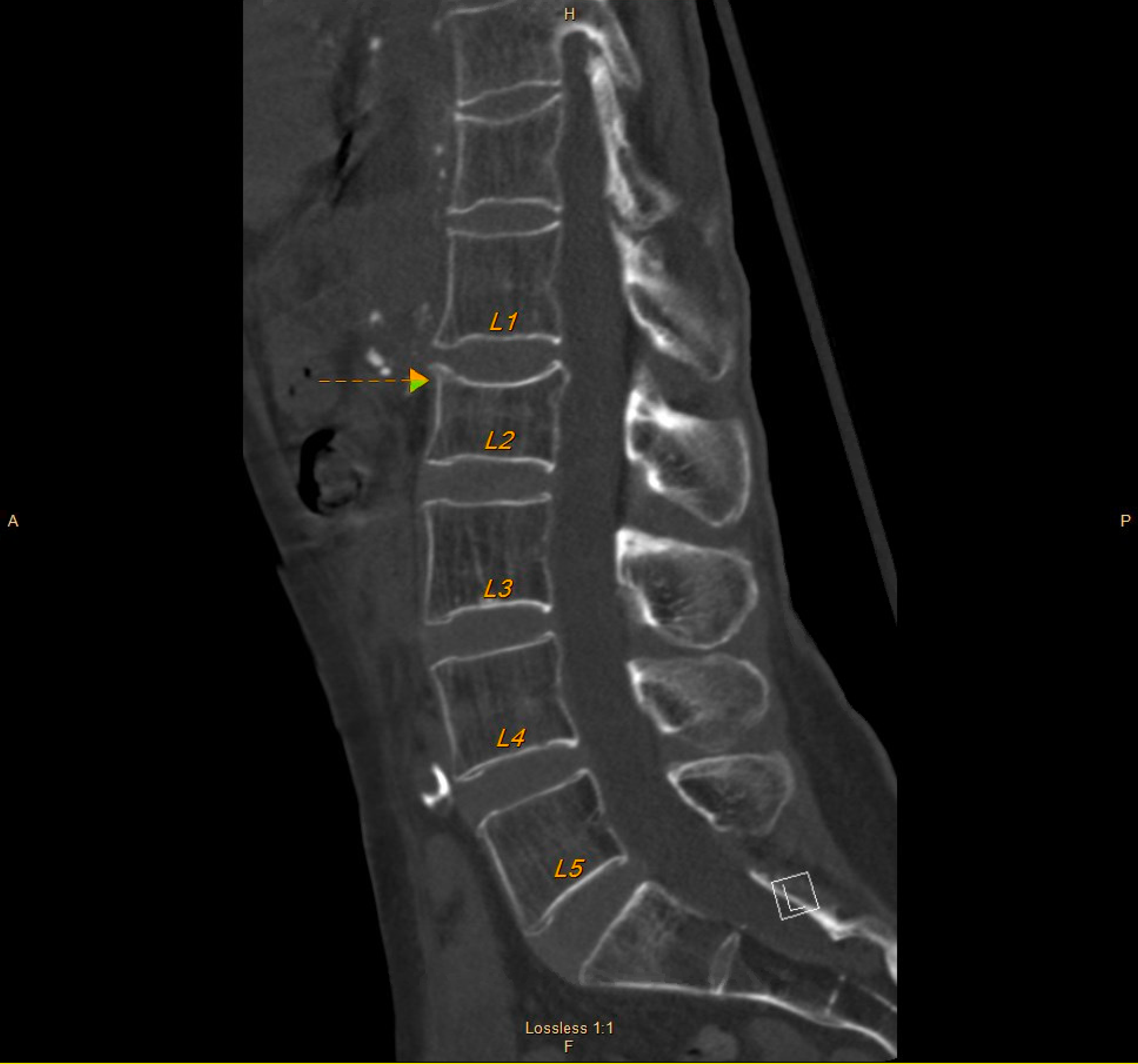Cureus Copper Deficiency Myeloneuropathy in Autoimmune Disease