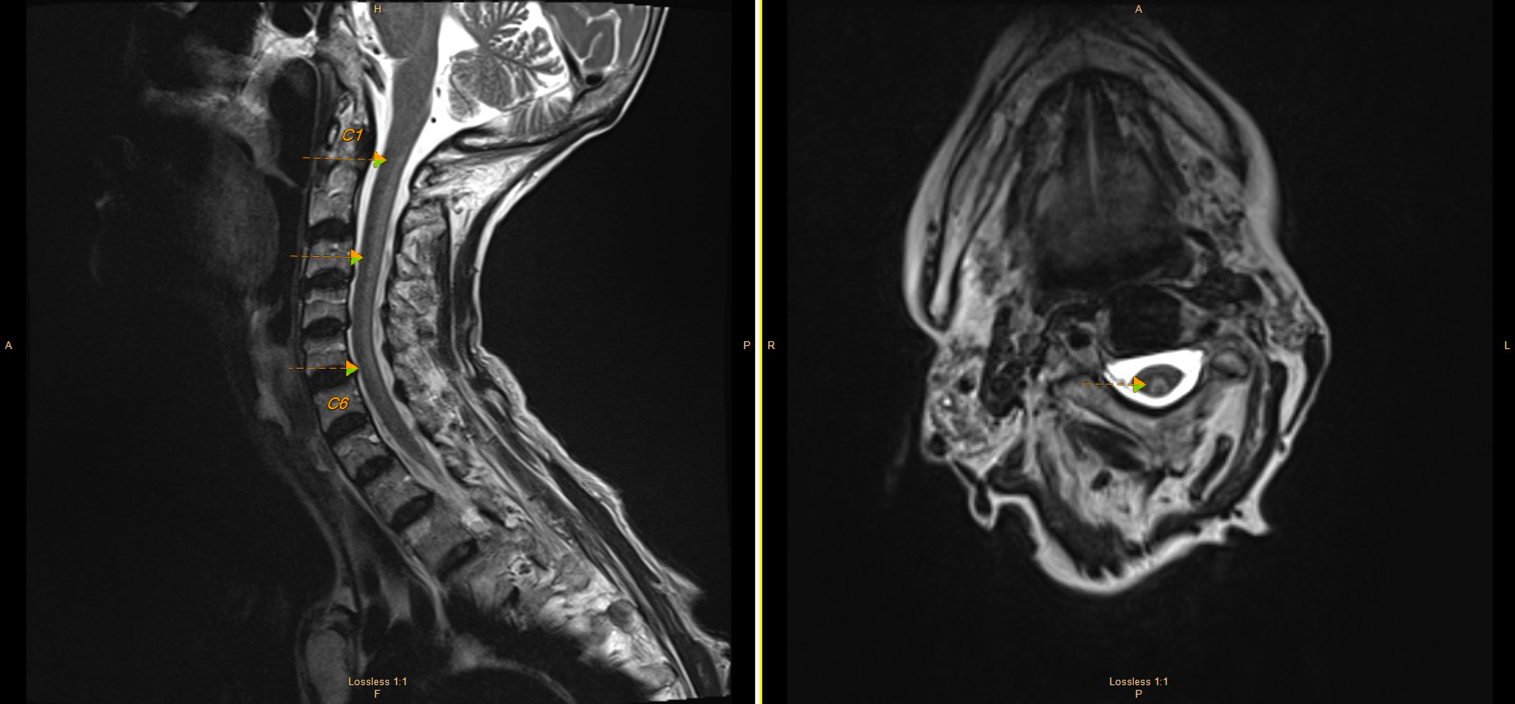 Cureus Copper Deficiency Myeloneuropathy in Autoimmune Disease