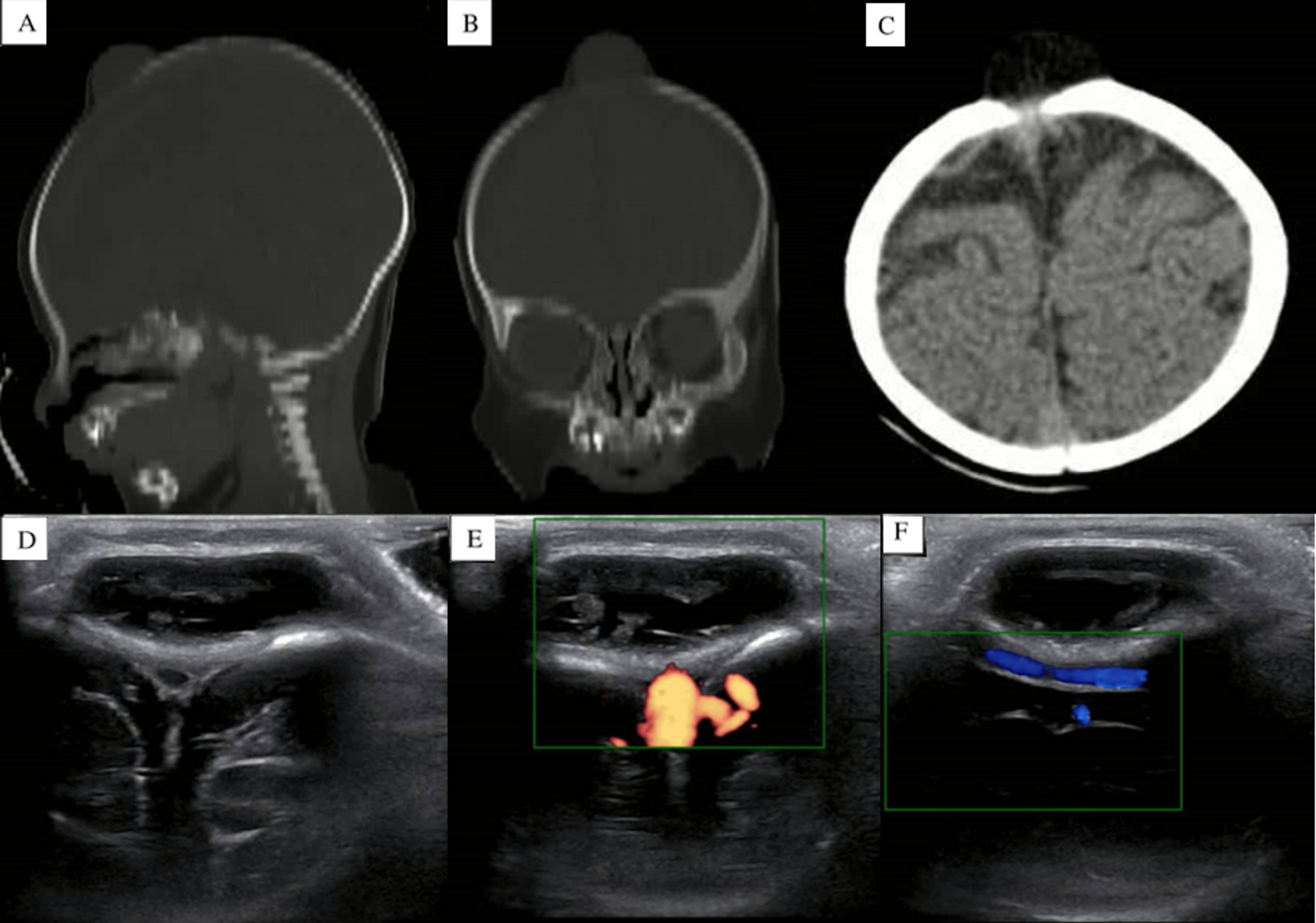 Cureus Anterior Fontanelle Dermoid Cyst Surgical Technique 9815