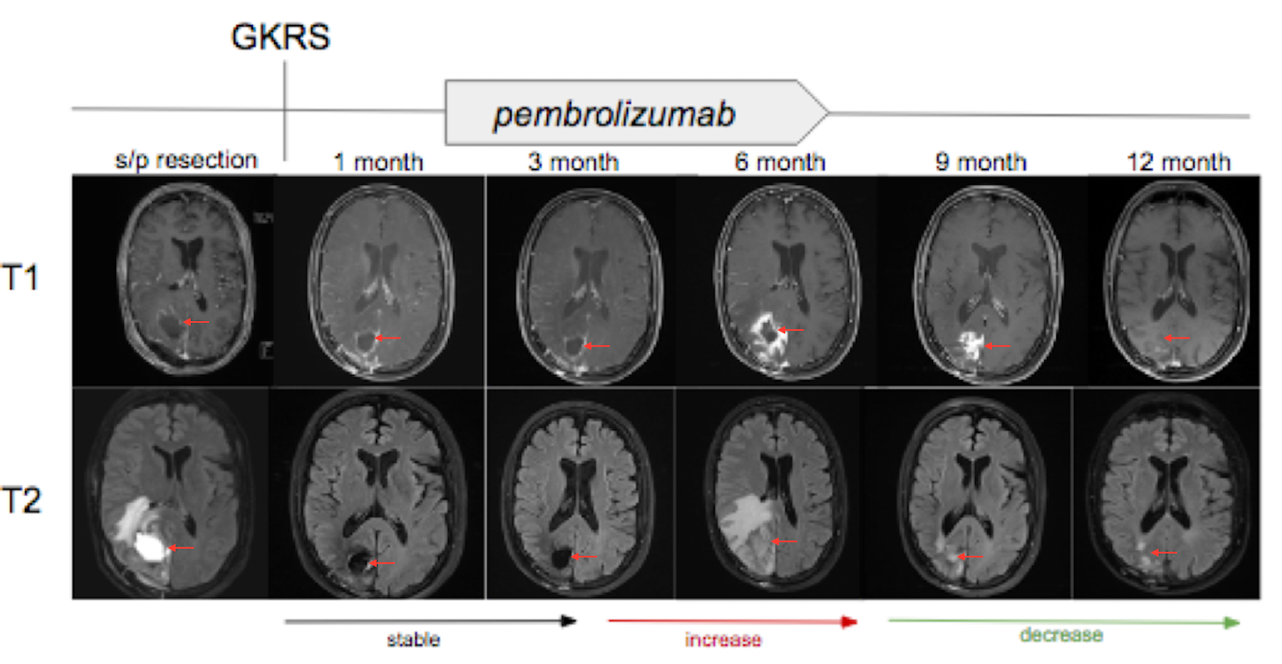 Cureus Effect of Gamma Knife Radiosurgery and Programmed Cell Death 1 Receptor Antagonists on