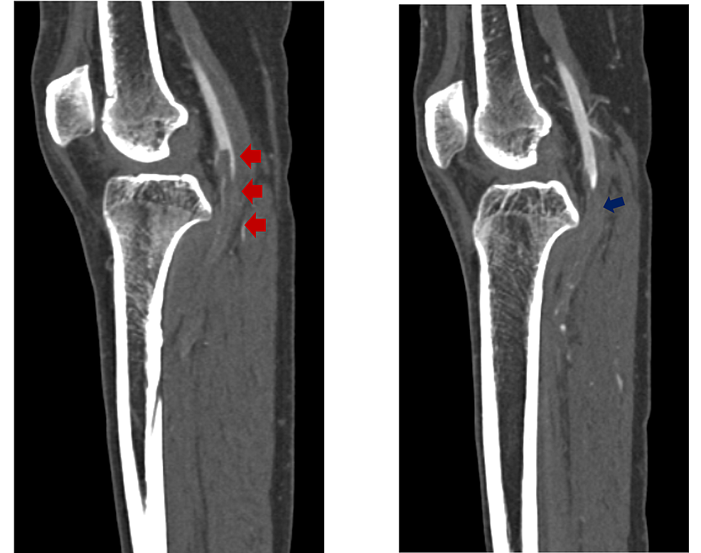 Cureus | Thrombosis of Bilateral Profunda Femoris, Anterior Tibial, and ...