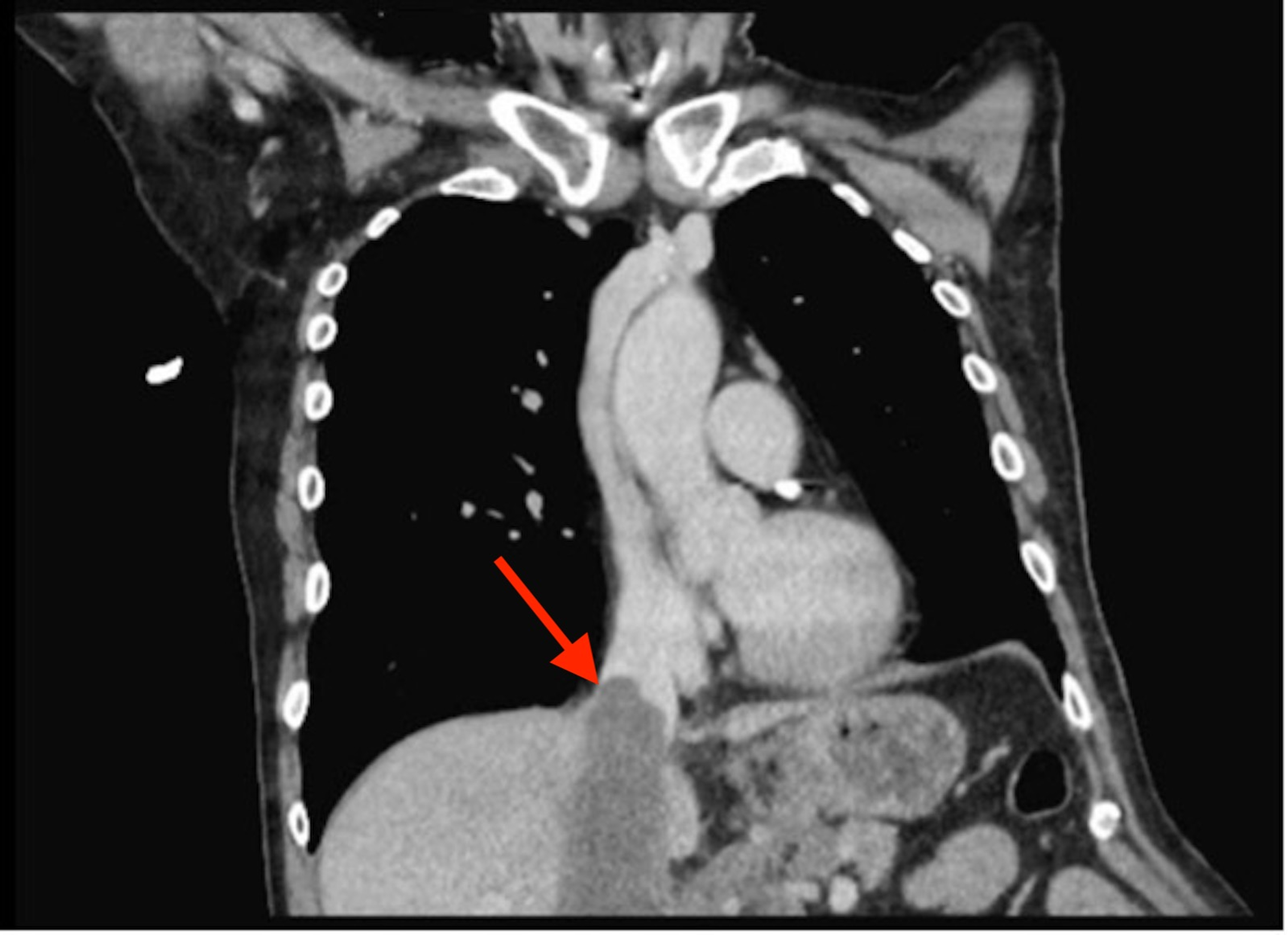 Cureus Inferior Vena Cava Tumor Thrombus Secondary To Mucinous