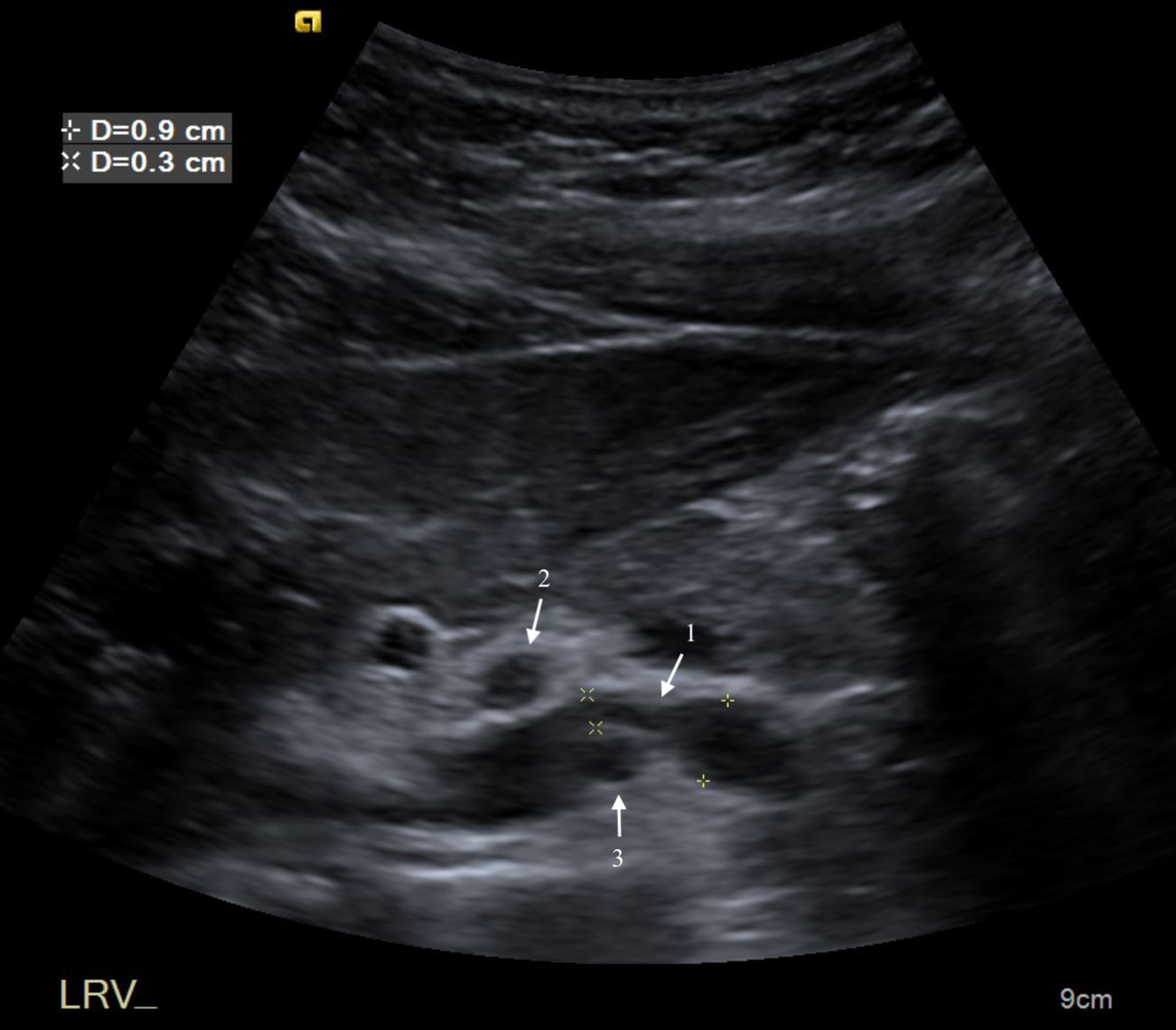 Cureus A Rare Cause of Abdominal and Flank Pain in Children Nutcracker Syndrome