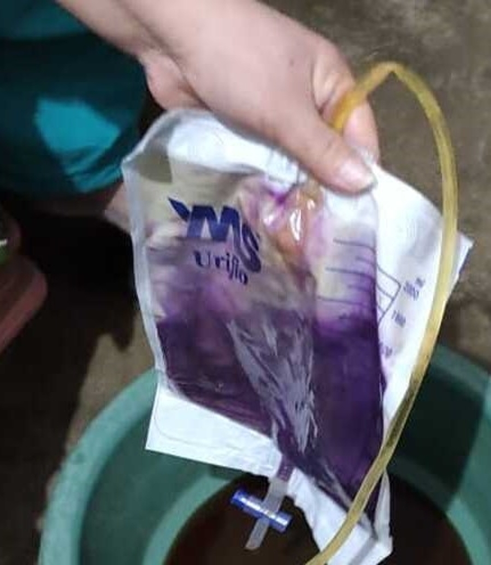 Purple Urine Bag Syndrome: A visual diagnosis and what it means for your  patient