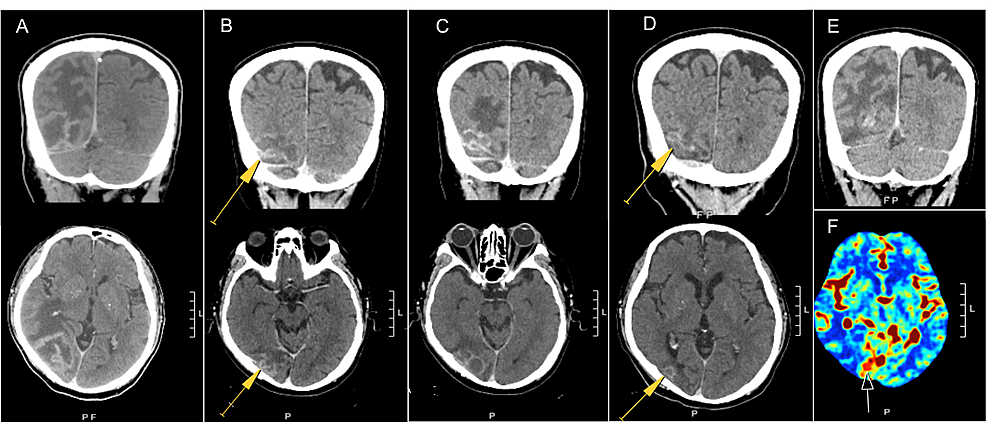 CT,-coronal-(top-panel),-and-axial-(bottom-panel)-views-of-the-brain-lesion