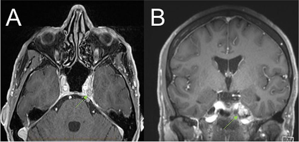 Magnetic-resonance-imaging-brain-(T1-weighted-gadolinium-enhanced)-taken-on-October-2018-–-Follow-up-imaging-13-months-post-Gamma-Knife-stereotactic-radiosurgery-with-(A)-transverse-and-(B)-coronal-views-demonstrating-recurrent-disease-in-the-left-Meckel's-cave.