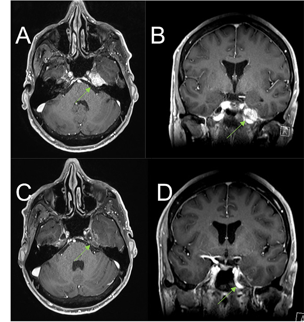 (A,--B)-MRI-brain-(T1-weighted-gadolinium-enhanced)-taken-on-October-2019.-Follow-up-study-29-months-post-GK-SRS-and-one-month-prior-to-repeat-GK-SRS-with-(A)-transverse-and-(B)-coronal-views-displaying-progressive-disease-in-left-Meckel's-cave-extending-to-the-cavernous-sinus.-(C,-D)-MRI-brain-(T1-weighted-gadolinium-enhanced)-taken-on-August-2020.-Follow-up-study-nine-months-after-repeat-GK-SRS-with-(C)-transverse-and-(D)-coronal-views-displaying-mild-early-post-treatment-effect-enhancement-in-the-adjacent-temporal-lobe.