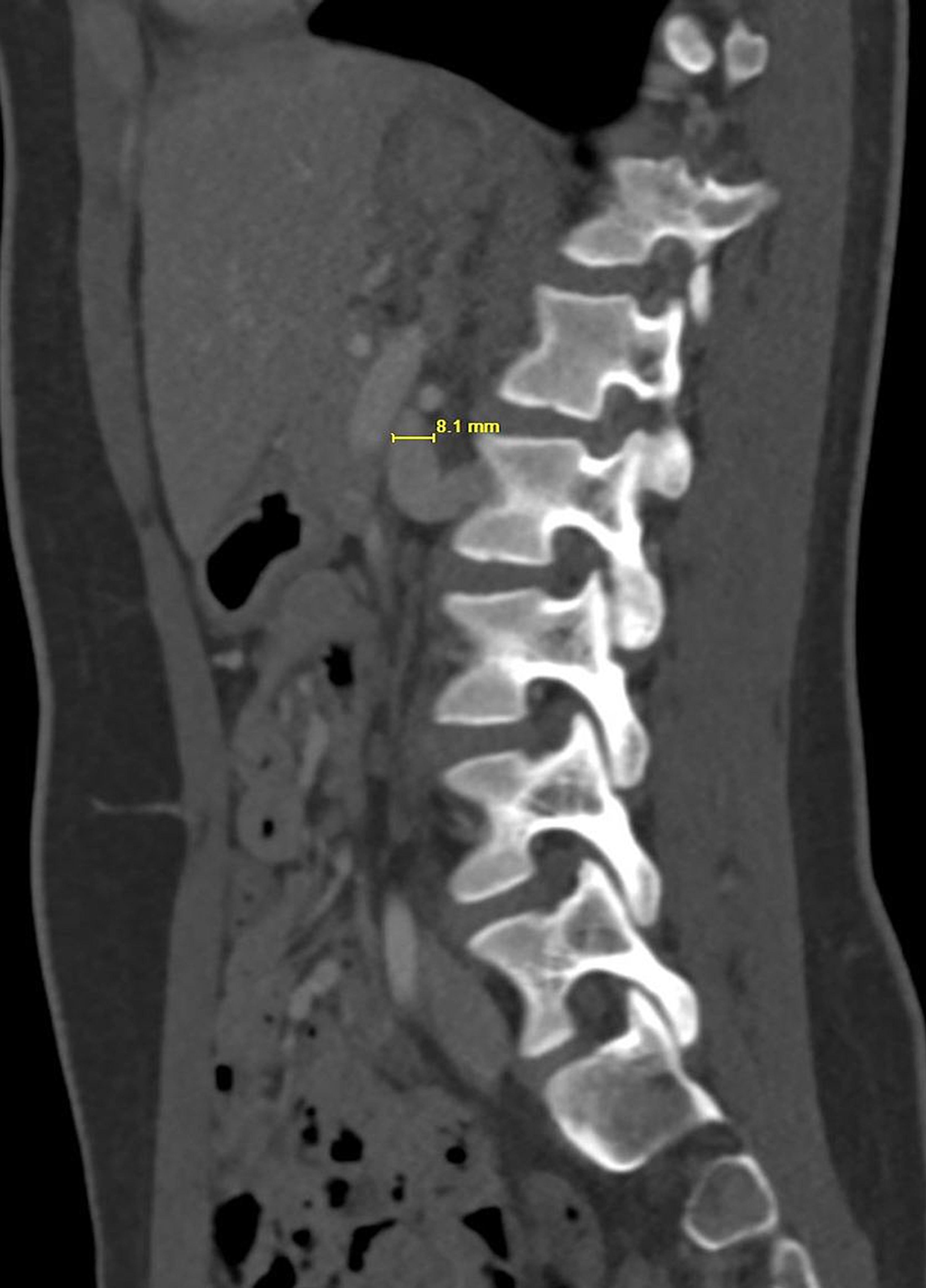 A Rare Cause of Abdominal and Flank Pain in Children Nutcracker