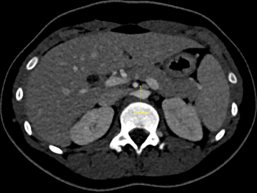 A Rare Cause of Abdominal and Flank Pain in Children Nutcracker