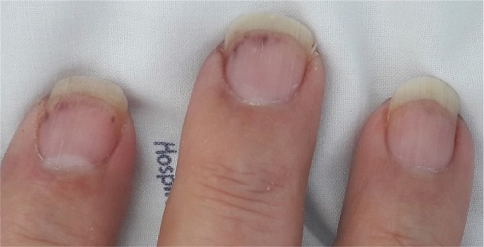 Splinter hemorrhage under the nails. | Download Scientific Diagram