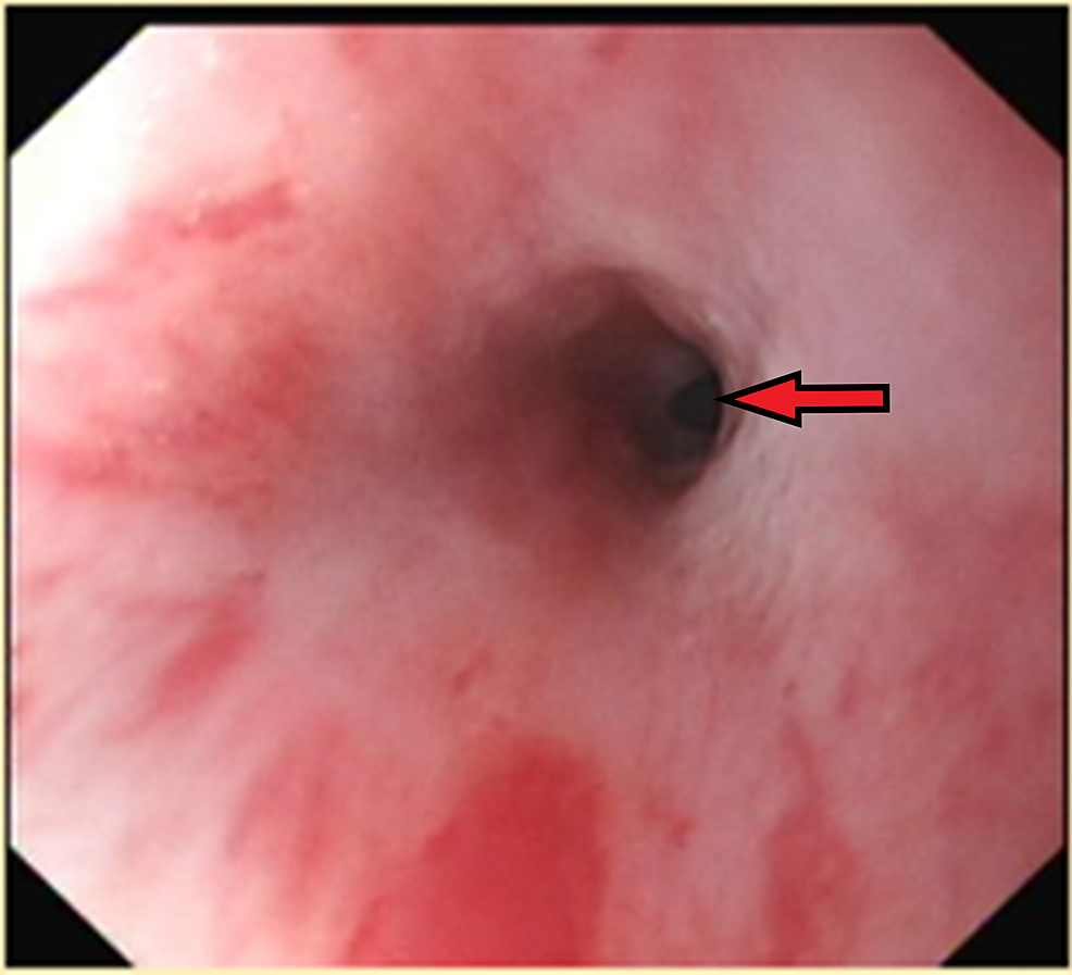 OGD-image-demonstrating-a-benign-mid-oesophageal-stricture